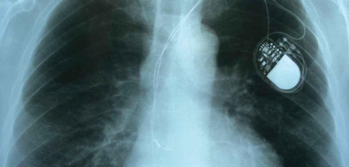 Pacemaker x-ray