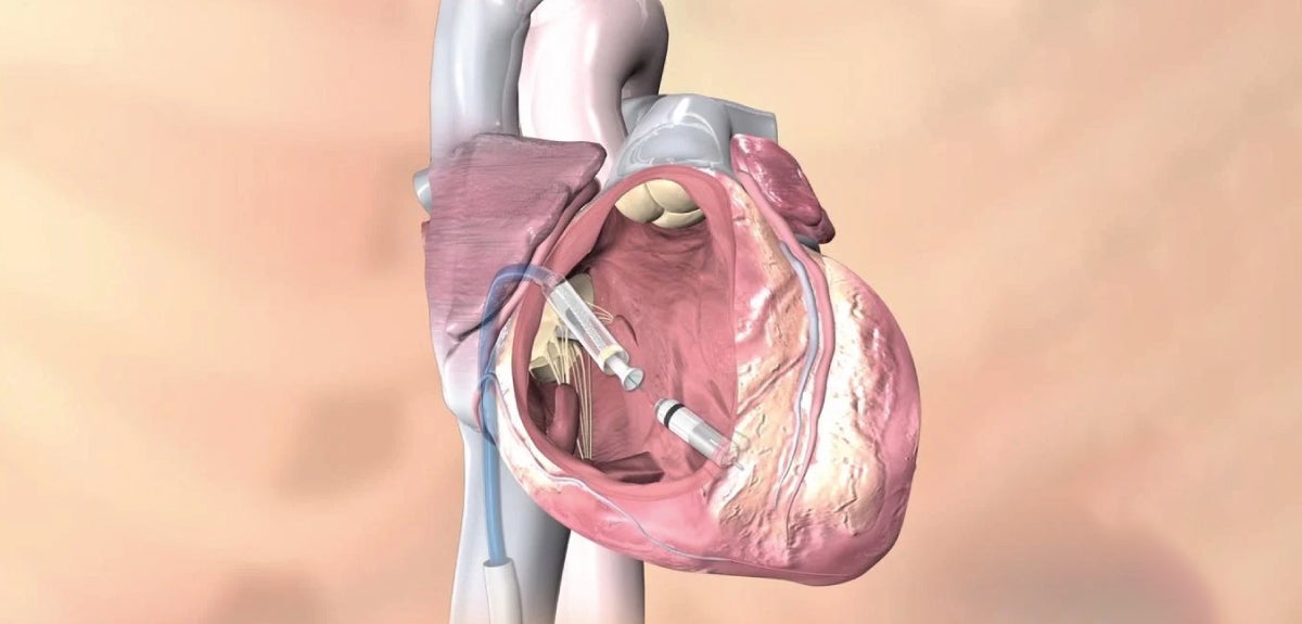 Micra Leadless Pacemaker