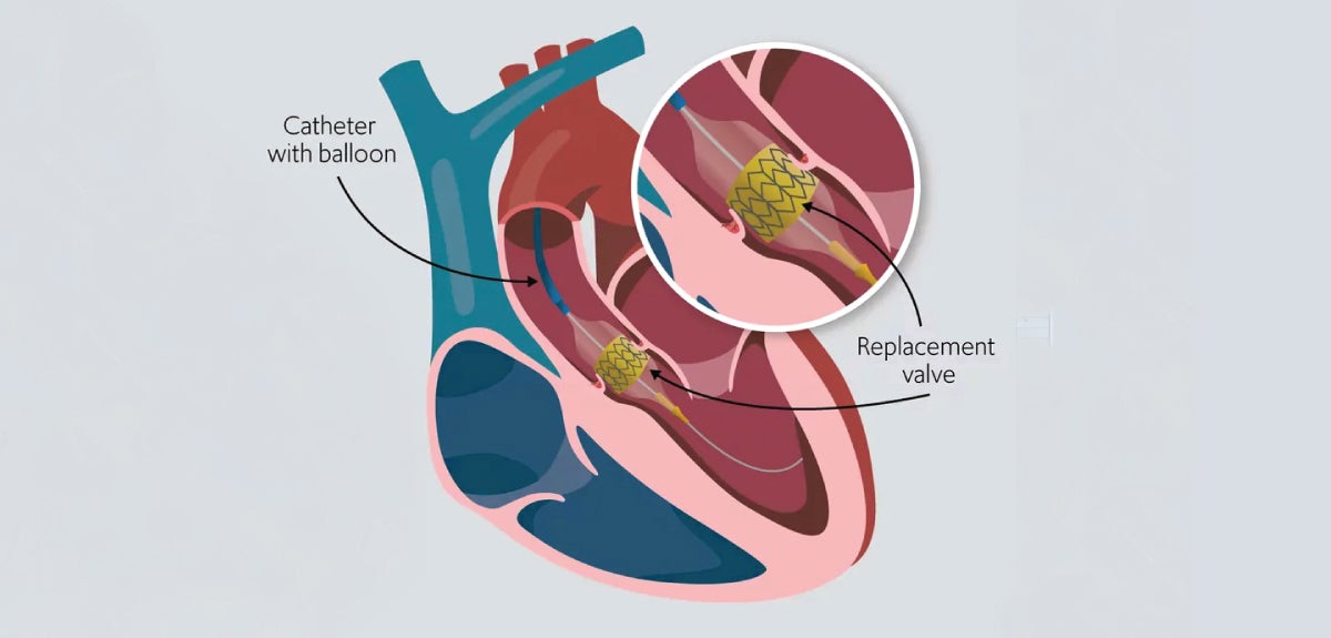 TAVR graphic